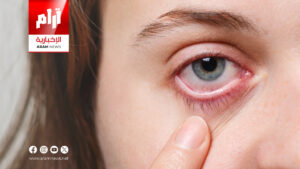 ما أسباب جفاف العين؟ وكيف يمكن مواجهته بطرق فعّالة؟ ما أسباب جفاف العين؟ وكيف يمكن مواجهته بطرق فعّالة؟