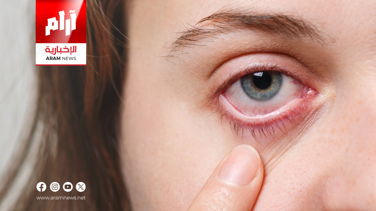 ما أسباب جفاف العين؟ وكيف يمكن مواجهته بطرق فعّالة؟